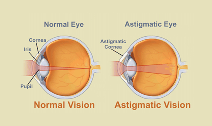 Comparison of a Normal Eye with Normal Vision and an Astigmatic Eye with Astigmatic Vision. Labels: Cornea, Iris, Pupil, Astigmatic Cornea.