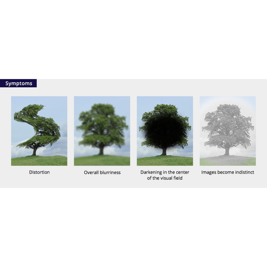 Symptoms: Distortion, Overall blurriness, Darkening in the center of the visual field, Images become indistinct.